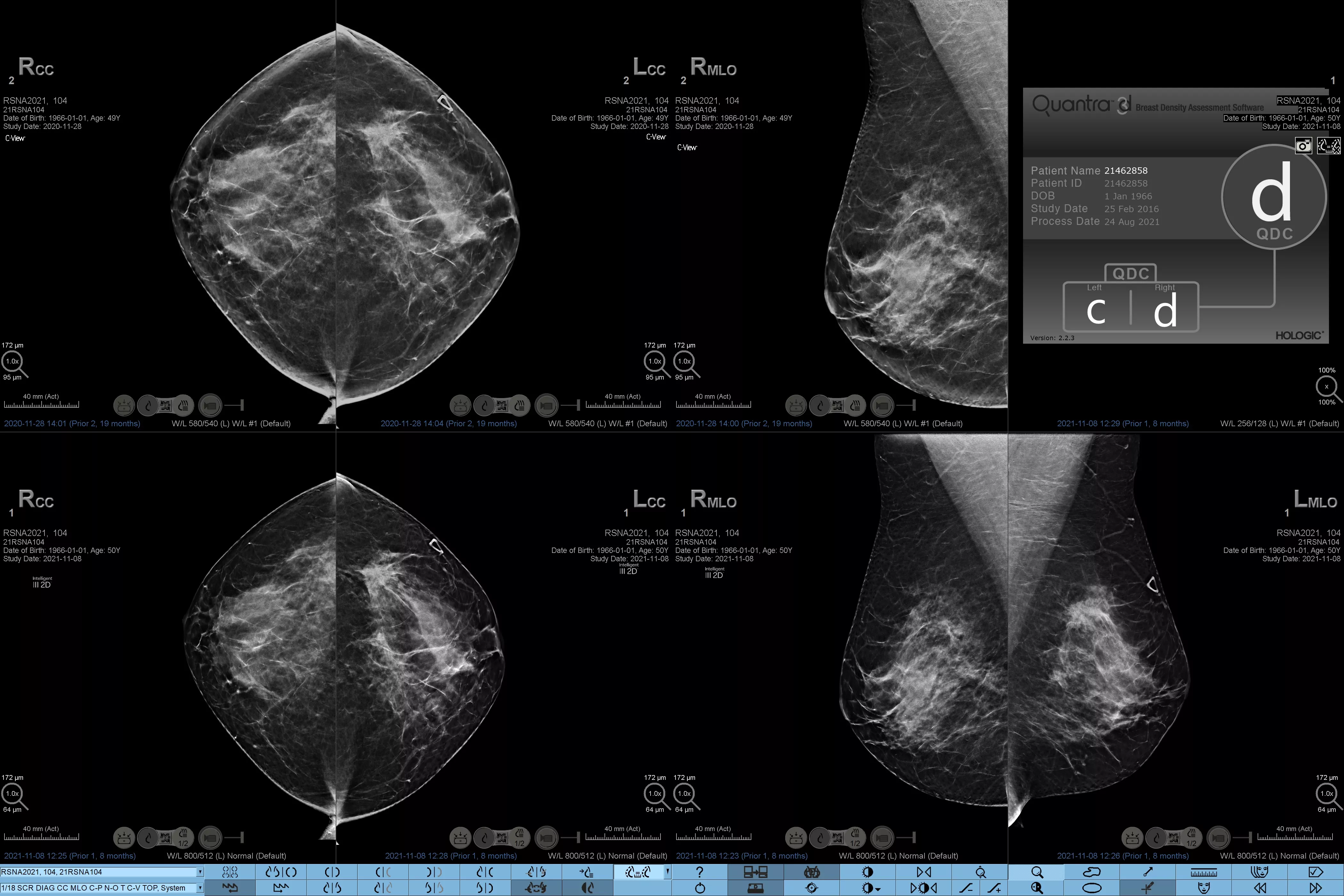 Diagnostic Breast Imaging 第2版 Diagnostic Imaging: Breast: 9781931884730: Medicine & Health